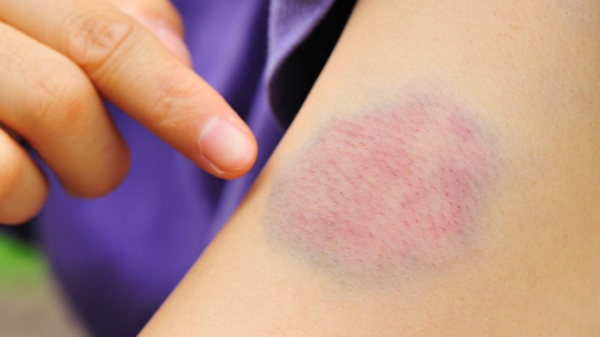 Ved leukemi får man ofte uforklarlige store blåmerker på huden. Foto: Shutterstock